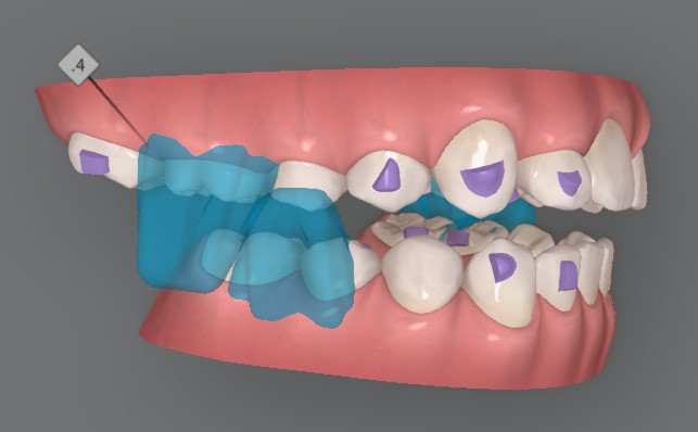 성장기 무턱교정 인비절라인 MA(mandibular advancment) 관련 이미지 5