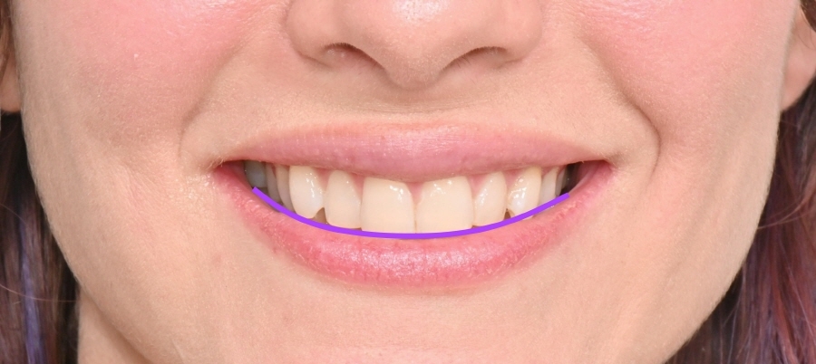 무삭제 라미네이트 vs 인비절라인 익스프레스 관련 이미지 2