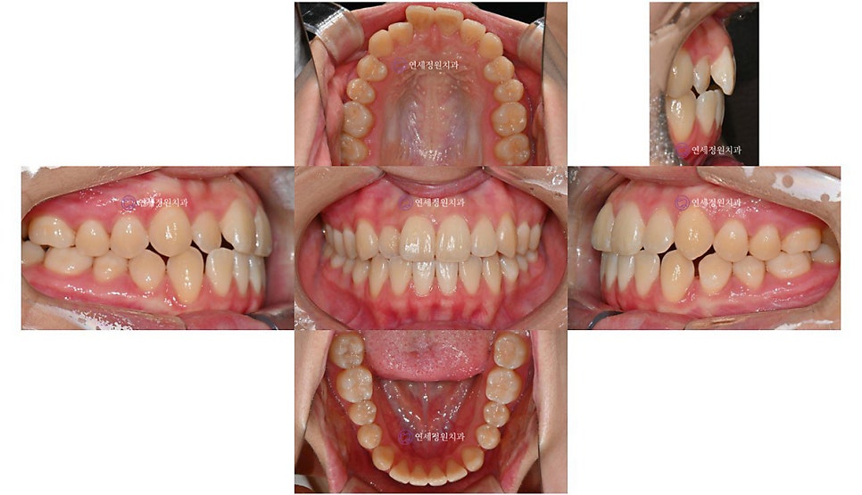 유학생 치아교정, 인비절라인 연세정원치과 관련 이미지 12