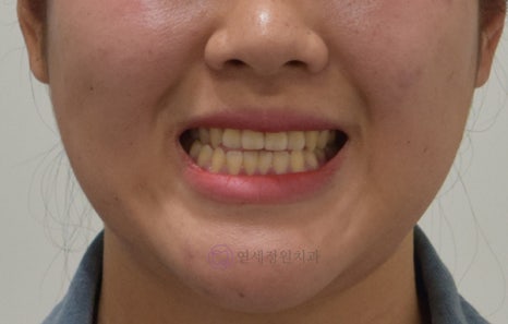 치아 중심선 비대칭 및 개방교합 교정, 대치동 연세정원치과 관련 이미지 6