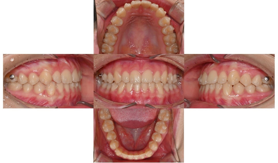 어린이 주걱턱, 페이스 마스크 성장교정 후 인비절라인 관련 이미지 9