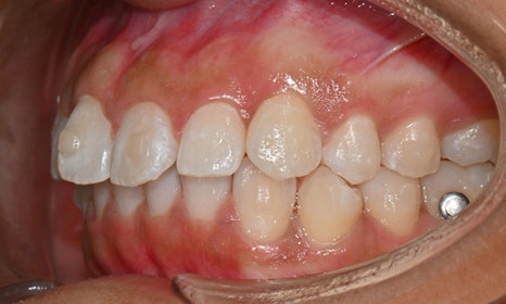 인비절라인 앞니 사이 공간 및 덧니 교정 관련 이미지 9