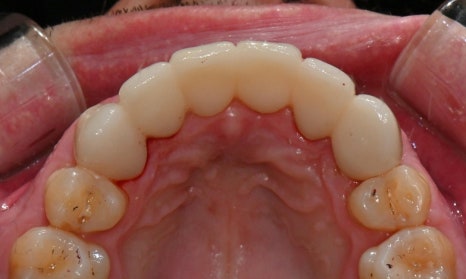 과개교합과 손상된 앞니, 심미와 기능을 함께 회복한 앞니 심미보철 케이스 관련 이미지 11