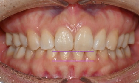 인비절라인 익스프레스 부분교정 <앞니 재교정> 관련 이미지 10