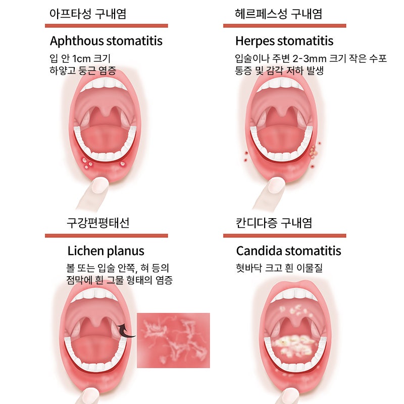 구내염, 원인부터 치료법 그리고 병원 선택 가이드 관련 이미지 3