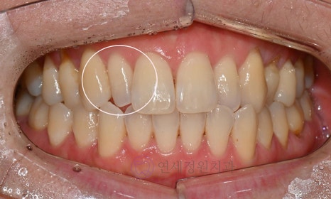 왜소치 치료 - 라미네이트 vs 레진비니어 vs 치아교정 관련 이미지 5