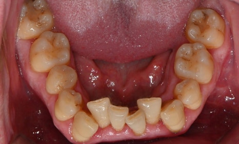 과개교합과 손상된 앞니, 심미와 기능을 함께 회복한 앞니 심미보철 케이스 관련 이미지 7