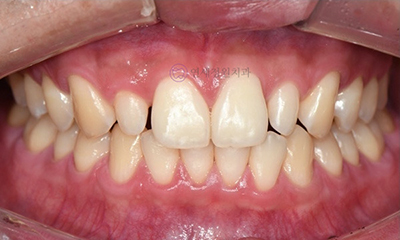 Front Tooth Resin Treatment in Korea: Microdontia, Gaps & Black Triangles 관련 이미지 2
