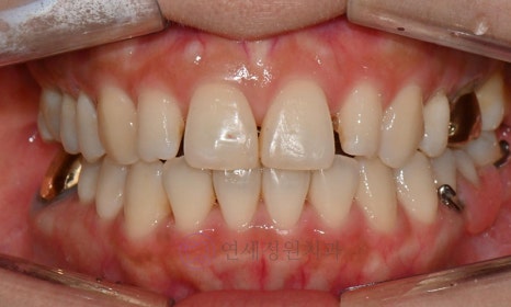 왜소치 치료 - 라미네이트 vs 레진비니어 vs 치아교정 관련 이미지 10