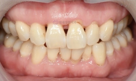 레진 비니어 등의 레진 치료를 이용한 앞니 형태 개선 (왜소치, diastema, black triangle) @ 대치동 연세정원치과 관련 이미지 4