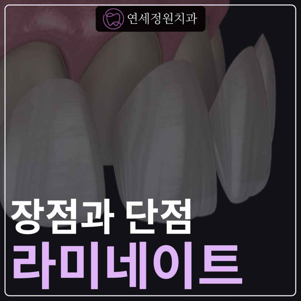 라미네이트 장점과 단점 대치동교정치과 연세정원치과 관련 이미지 1