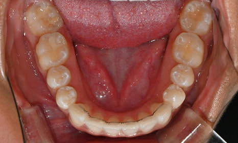 개포동 앞니 사이 공간 및 덧니 교정을 원한다면 관련 이미지 16