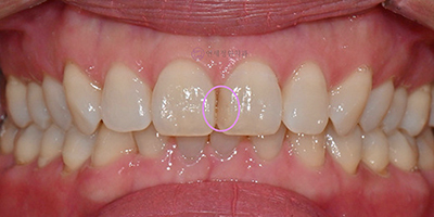 Dental Bonding for Gaps Between Front Teeth & Black Triangles | Gangnam, Seoul 관련 이미지 8