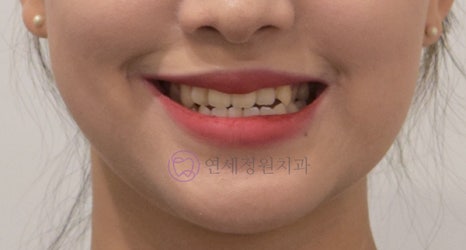 얼굴 비대칭과 치아 비대칭의 관계|치아 교정으로 개선할 수 있을까? 관련 이미지 7