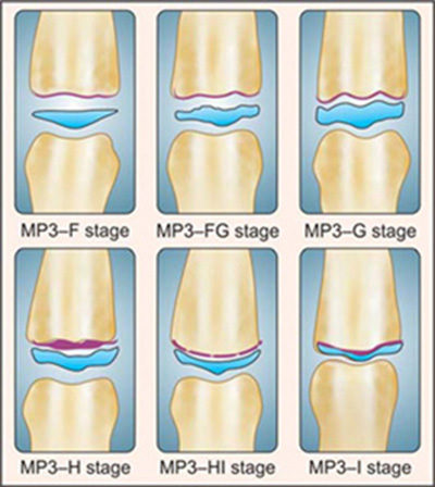대치동 성장기 아이 치아교정의 최적기는? 관련 이미지 4