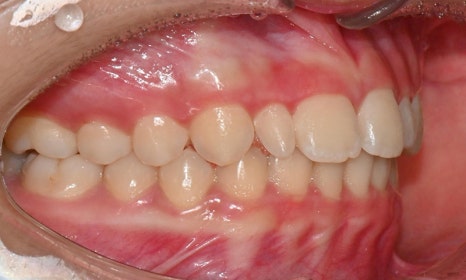 왜소치 치료 - 라미네이트 vs 레진비니어 vs 치아교정 관련 이미지 23