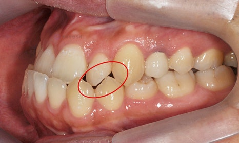 주걱턱 치아 교정만으로 치료 가능할까요? @ 대치동 교정치과 연세정원치과 관련 이미지 4