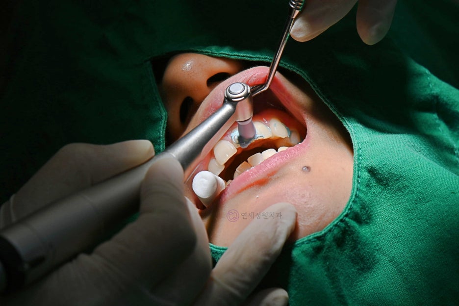 One Day Teeth Whitening Process @ Yonsei JW Dental Clinic 관련 이미지 3