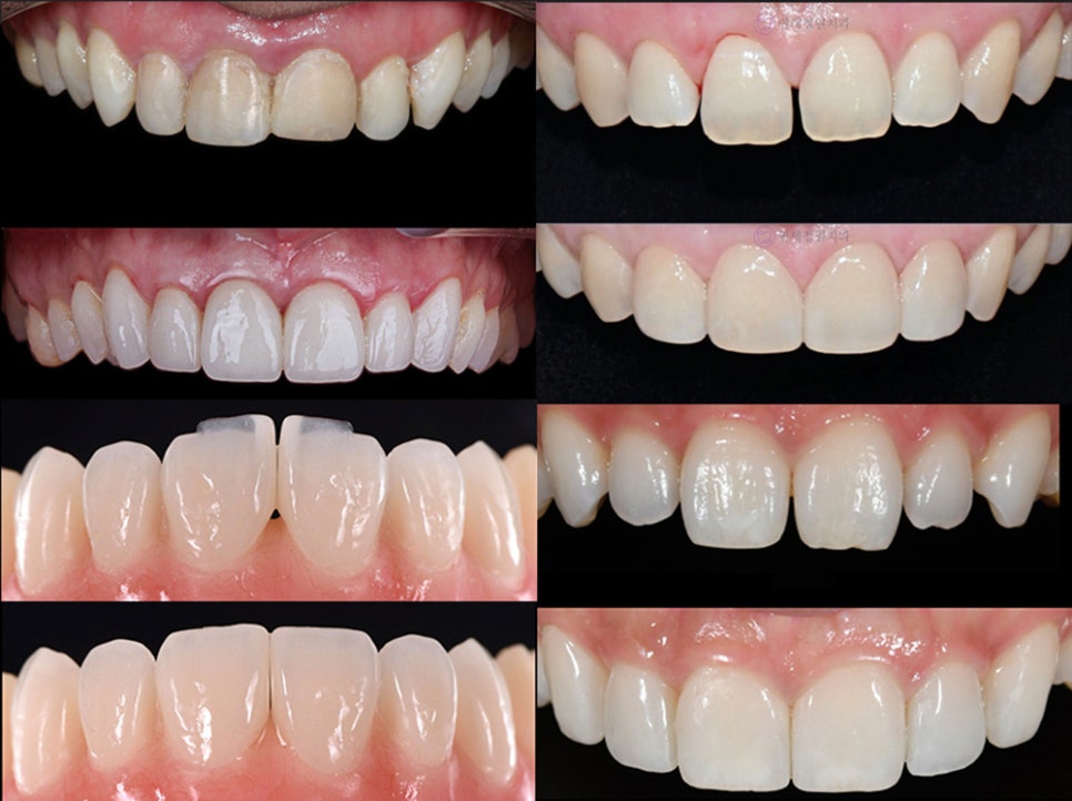 Non-Prep and Minimal-Prep Veneers in Seoul&ndash; Costs & What to Expect 관련 이미지 3