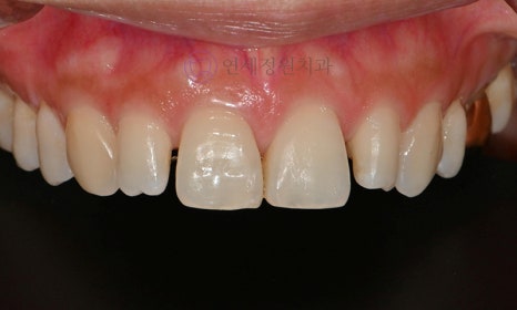 왜소치 치료 - 라미네이트 vs 레진비니어 vs 치아교정 관련 이미지 11