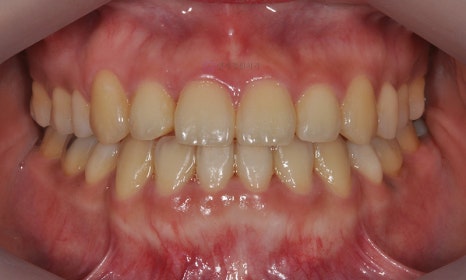 비수술 주걱턱 교정, 대치동 교정치과 연세정원치과 관련 이미지 13