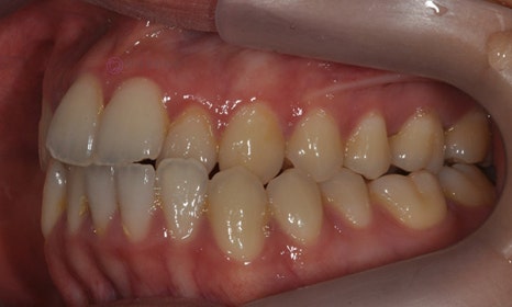 비대칭 및 돌출입 치아교정, 대치동 교정치과 연세정원치과 관련 이미지 15