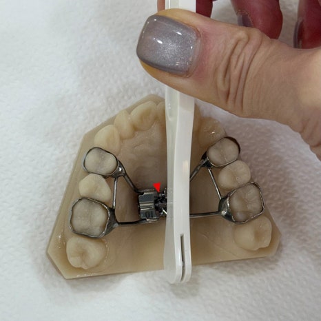 악궁확장장치(RPE, MARPE, MSE) 돌리는 방법 관련 이미지 13