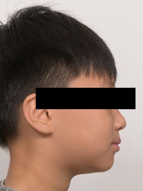 어린이 무턱 액티베이터 성장교정 후 인비절라인 퍼스트 관련 이미지 5