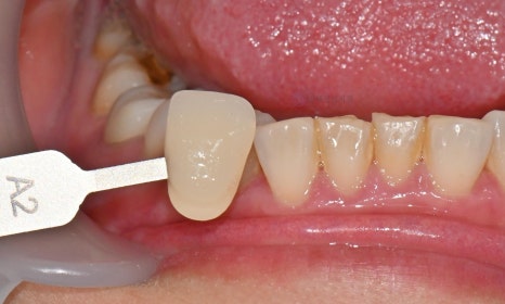 원데이 치아미백 - 앞니 크라운 사례 관련 이미지 4