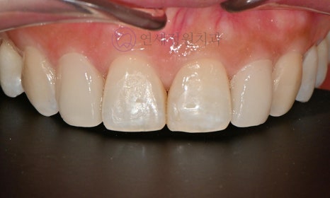 왜소치 치료 - 라미네이트 vs 레진비니어 vs 치아교정 관련 이미지 18