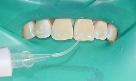 앞니 치아 하얀 점, 충치인가요? (화이트 스팟, 반점치) 아이콘 레진 치료의 순서 관련 이미지 7