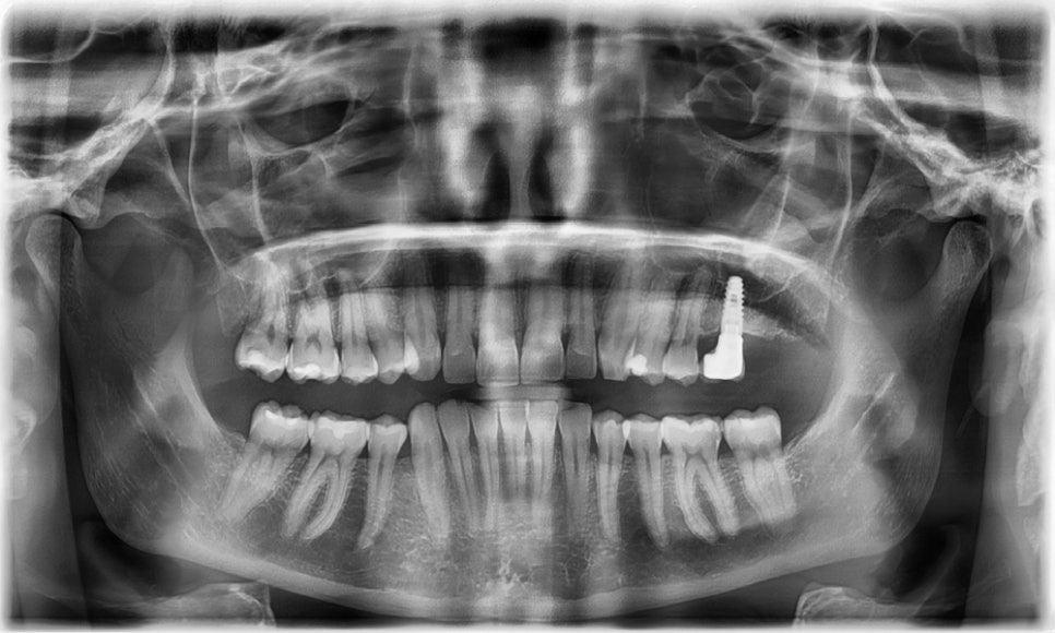 무삭제 라미네이트 vs 인비절라인 익스프레스 관련 이미지 4
