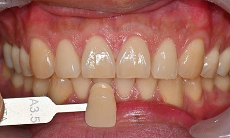 Teeth Whitening Case : A couple from the Netherlands 관련 이미지 2