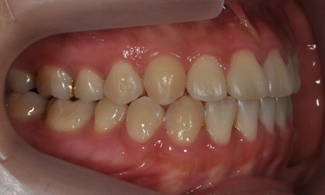 치아 중심선 비대칭 및 개방교합 교정, 대치동 연세정원치과 관련 이미지 7