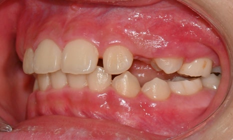 Why Is a Second Phase of Orthodontic Treatment Needed After the First? – A Case of Invisalign Treatment for a Growing Patient with Anterior Crossbite image 7