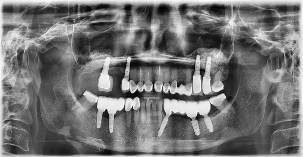 심미와 기능을 모두 고려한 앞니 심미보철 재치료 관련 이미지 2