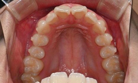 고등학생 인비절라인 교정｜앞니 치아배열 &middot; 과개교합 관련 이미지 10