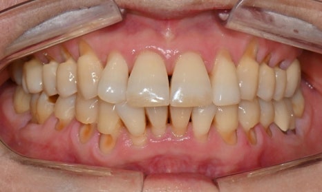 대치동 치경부 레진 & 중년교정 & 치아미백으로 자연스러운 미소를! 관련 이미지 7