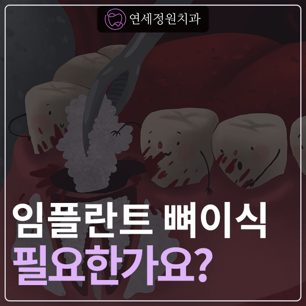 임플란트 뼈이식 정말로 필요한가요? 관련 이미지 1
