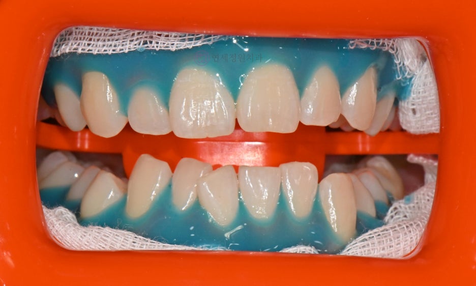 One Day Teeth Whitening Process @ Yonsei JW Dental Clinic 관련 이미지 11