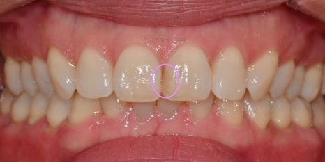 앞니 심미 레진 치료 : 블랙트라이앵글, 앞니 사이 공간 @ 대치동 연세정원치과 관련 이미지 8