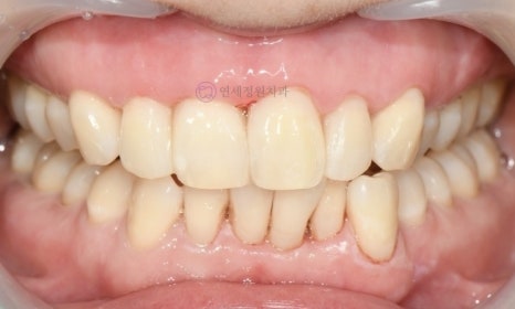 레진 비니어 등의 레진 치료를 이용한 앞니 형태 개선 (왜소치, diastema, black triangle) @ 대치동 연세정원치과 관련 이미지 12