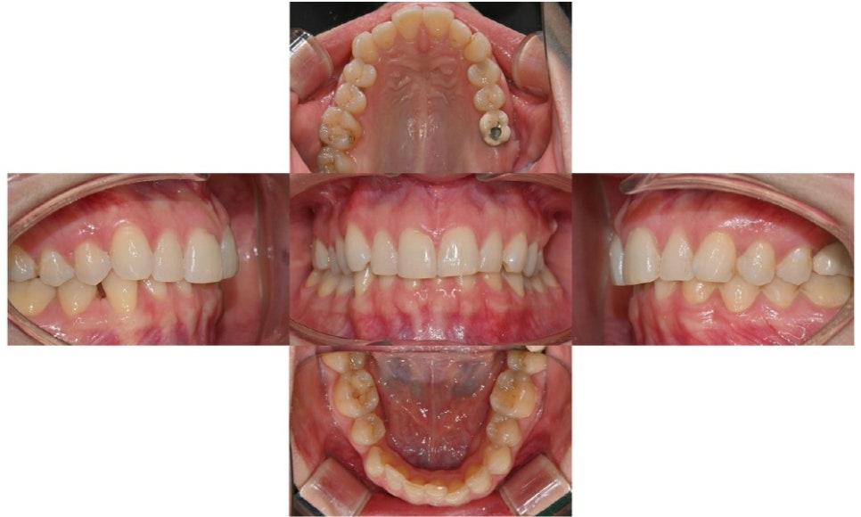 무삭제 라미네이트 vs 인비절라인 익스프레스 관련 이미지 3