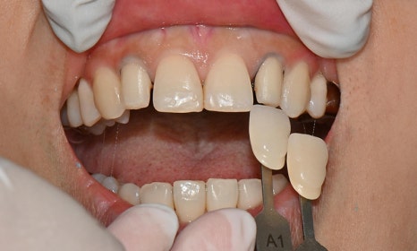 왜소치 치료 - 라미네이트 vs 레진비니어 vs 치아교정 관련 이미지 15