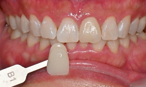 원데이 치아미백 - 앞니 크라운 사례 관련 이미지 7