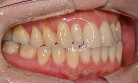 왜소치 치료 - 라미네이트 vs 레진비니어 vs 치아교정 관련 이미지 6
