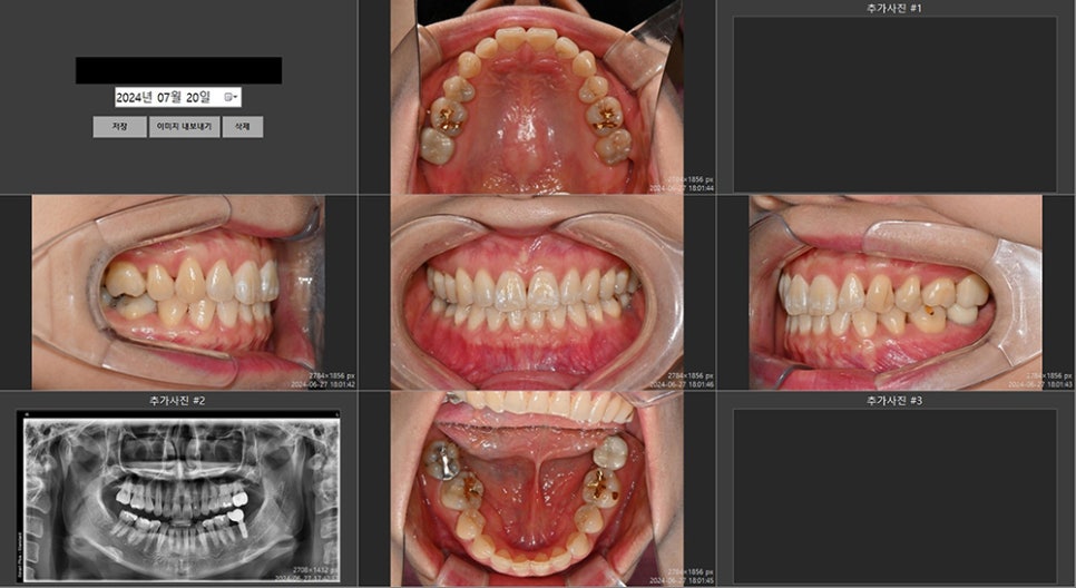 대치동교정치과에서 정밀진단은 어떤 건가요? 연세정원치과 관련 이미지 2