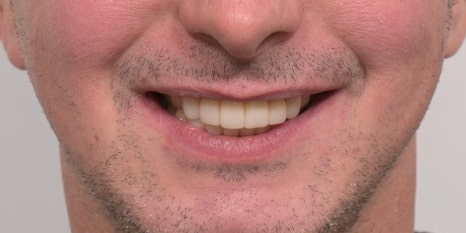 과개교합과 손상된 앞니, 심미와 기능을 함께 회복한 앞니 심미보철 케이스 관련 이미지 14