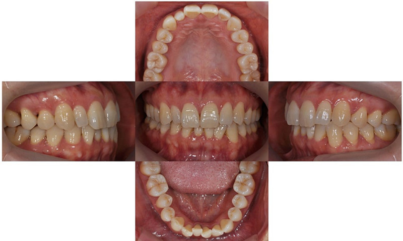 중년의 치아교정 시 고려할 사항, 대치동 연세정원치과 관련 이미지 6