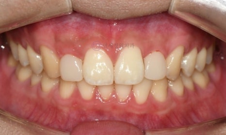 레진 비니어 등의 레진 치료를 이용한 앞니 형태 개선 (왜소치, diastema, black triangle) @ 대치동 연세정원치과 관련 이미지 6
